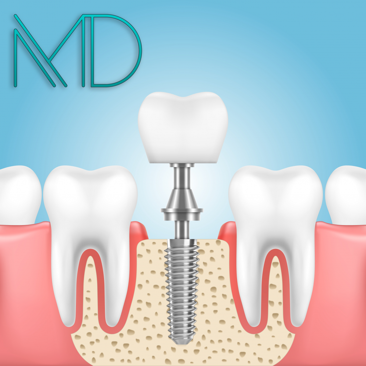 Fogászati implantátumok - Magic Dental tannlegekontor