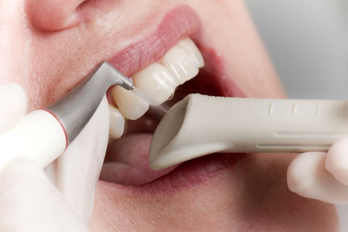 Professzionális fogkőeltávolítás provided by our dentist Dr. Varga Alexandra