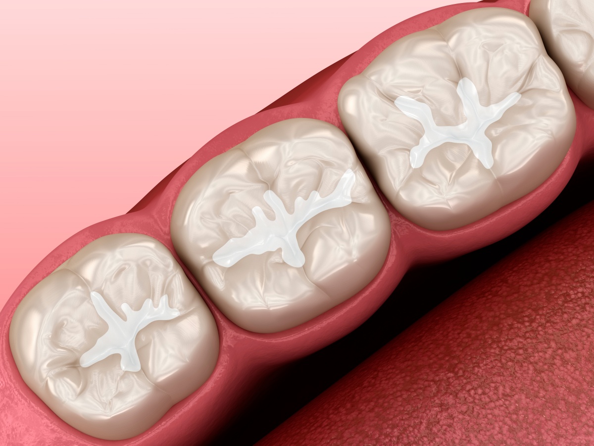 Barázdazárás - Magic Dental fogászat