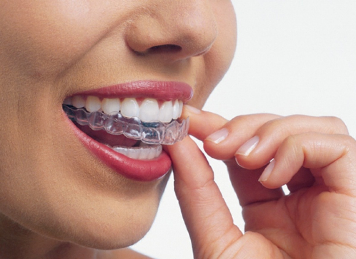 Biteskinne - Magic Dental tannlegekontor
