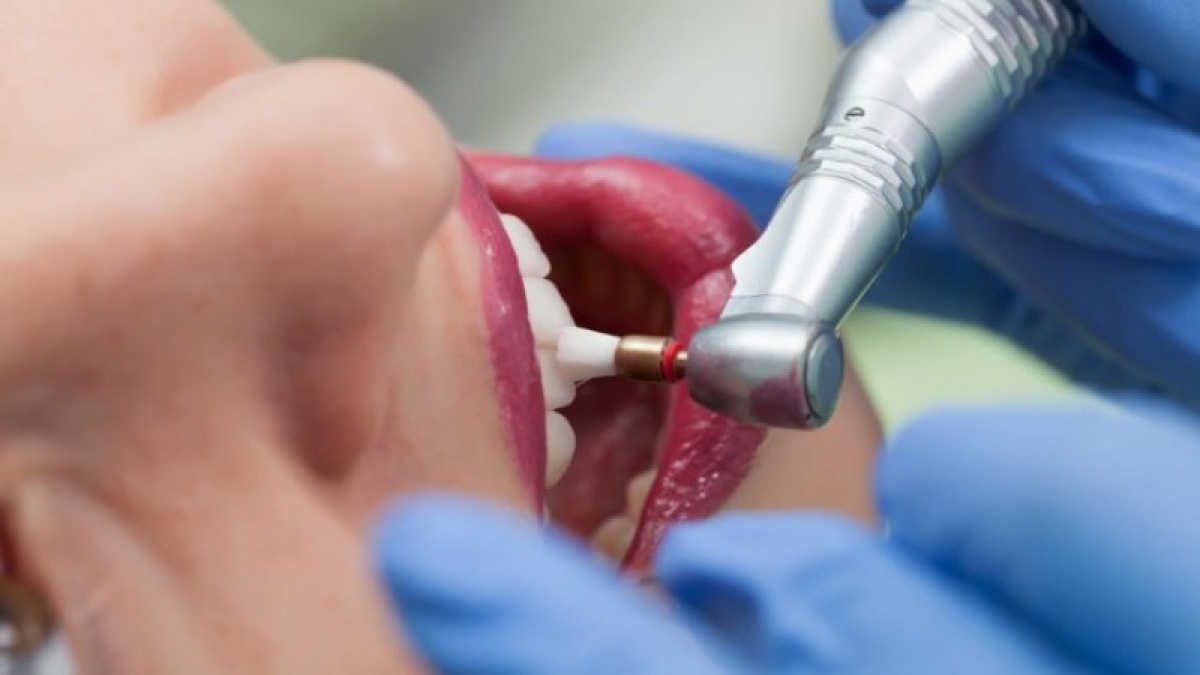 Polírozás - Magic Dental fogászat