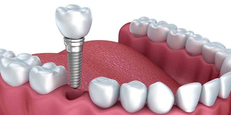 Implantátum